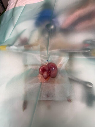 Eriza Ada. Neoplasia en cuerno uterino izquierdo, imagen intraoperatoria.